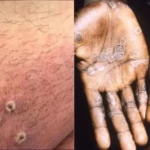 Viruela-del-mono-Argentina