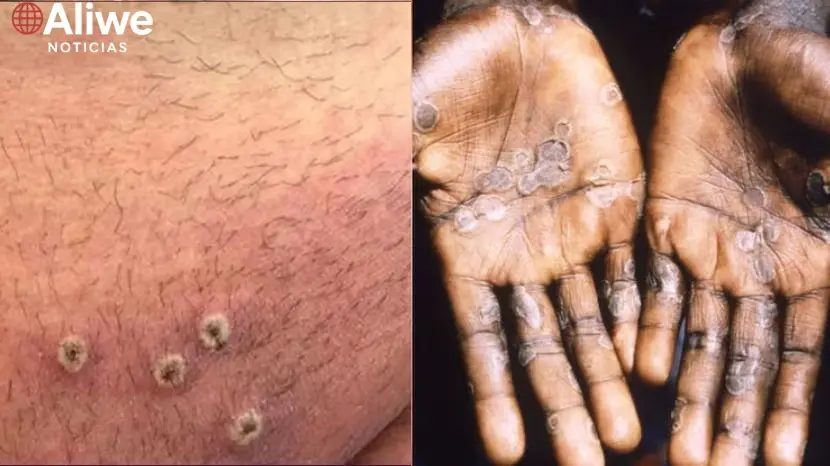 Viruela-del-mono-Argentina